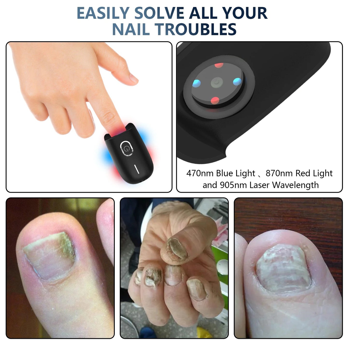 KTS Nail Fungus Laser Device Toenail Laser Therapy Machine - Supersell