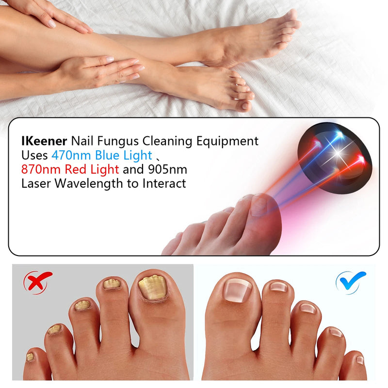 KTS Nail Fungus Laser Device Toenail Laser Therapy Machine - Supersell