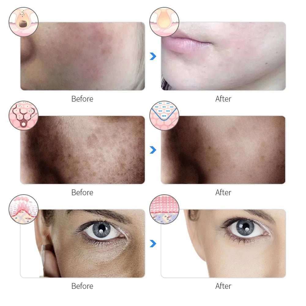 Skin Rejuvenation Facial Photon Light Therapy Device - Supersell